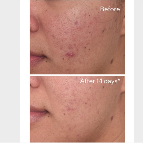 😊 NIB Murad Environmenral Sheild Rapid Dark Spot Correcting Serum 0.17 fl oz 😊 - Picture 5 of 7